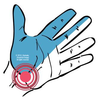 Carpal Tunnel Syndrome (CTS)